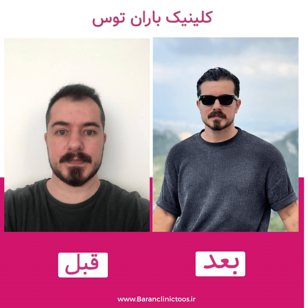 کاشت مو به روش fit در مشهد 